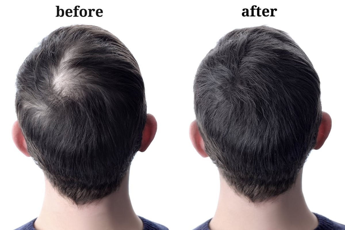 Men's hair before and after density fill treatment — cosmetic SMP density comparison