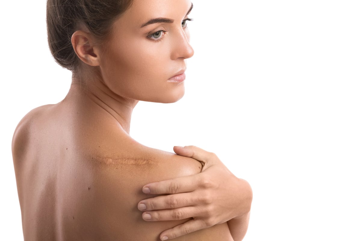 Woman with a scar on shoulder, ideal candidate for scar camouflage micropigmentation