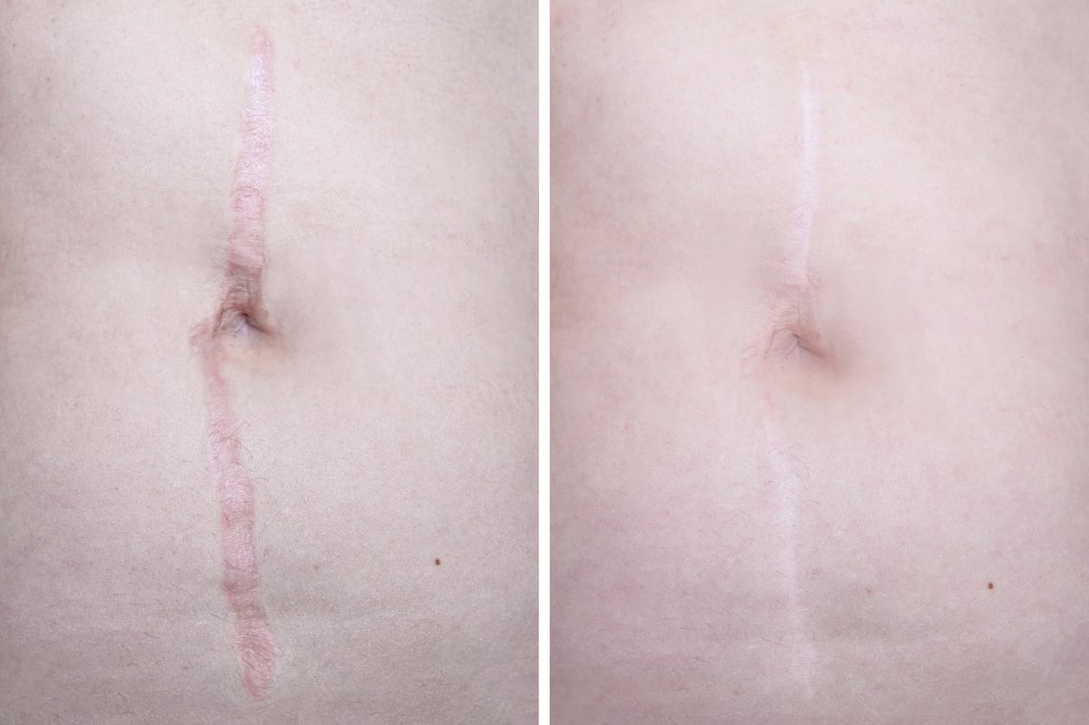 scar-camouflage-before-after-results-birmingham-alabama