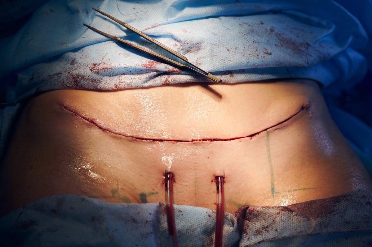 Close up of female belly with suture line after tummy tuck surgery — scar camouflage candidate