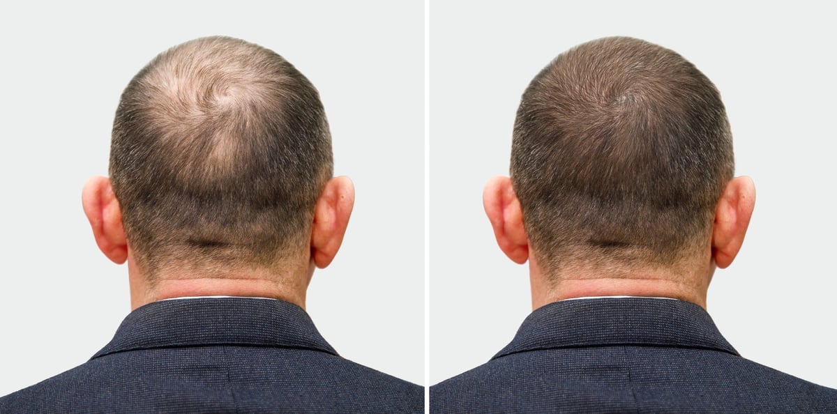 Before and after comparison of male crown scalp micropigmentation result