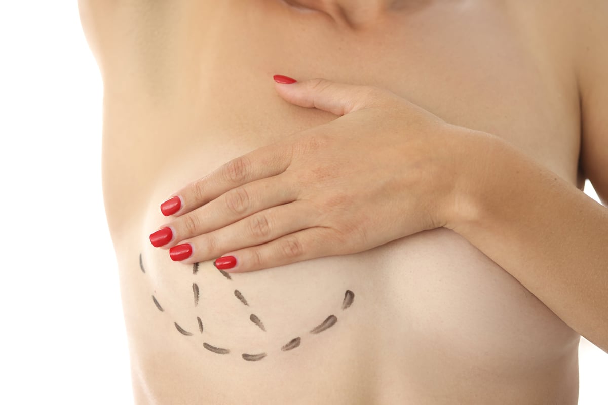 Woman breasts marked for cosmetic surgery — breast lift scar camouflage and stretch marks candidate