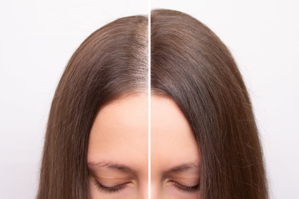 Before and after of a young woman with receding hairline — female density SMP transformation