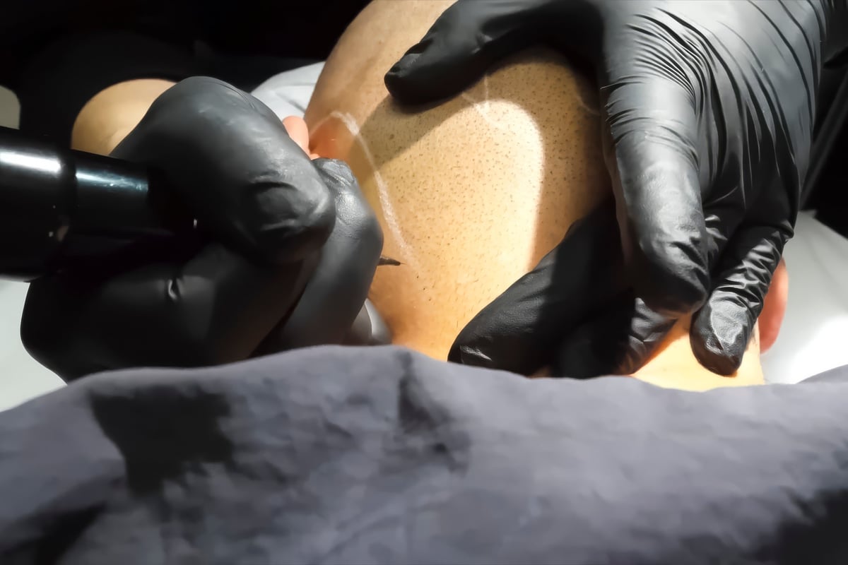 Tattooing with a needle on the scalp in the form of shaved hair. Permanent makeup for bald people to imitate hair follicles. Black medical gloves on a tattoo artist