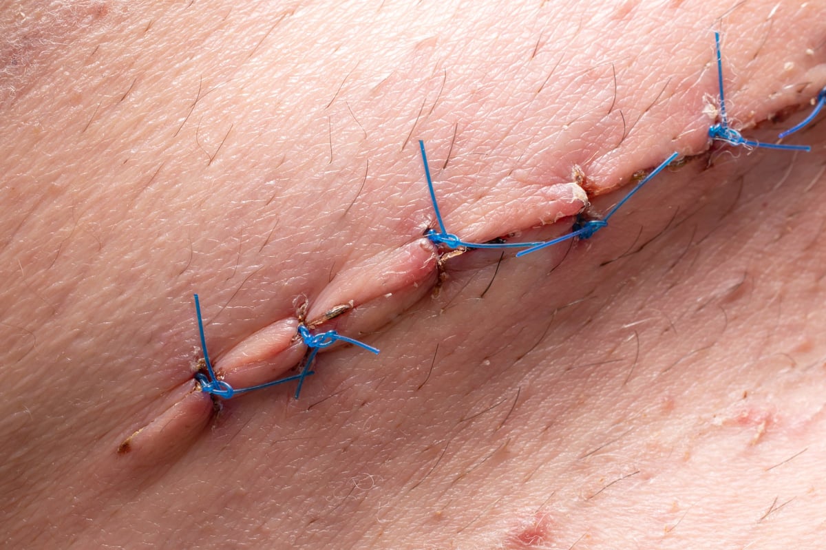 Surgical medical sutures on skin — all surgical scar types camouflage candidate