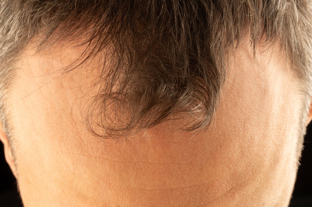 Close-up zoomed in view of man's hairline and forehead showing natural buzzed hairline detail