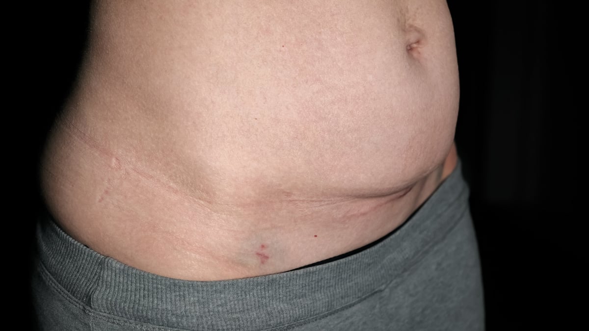 Fresh medical scars on female abdomen — c-section scar camouflage candidate