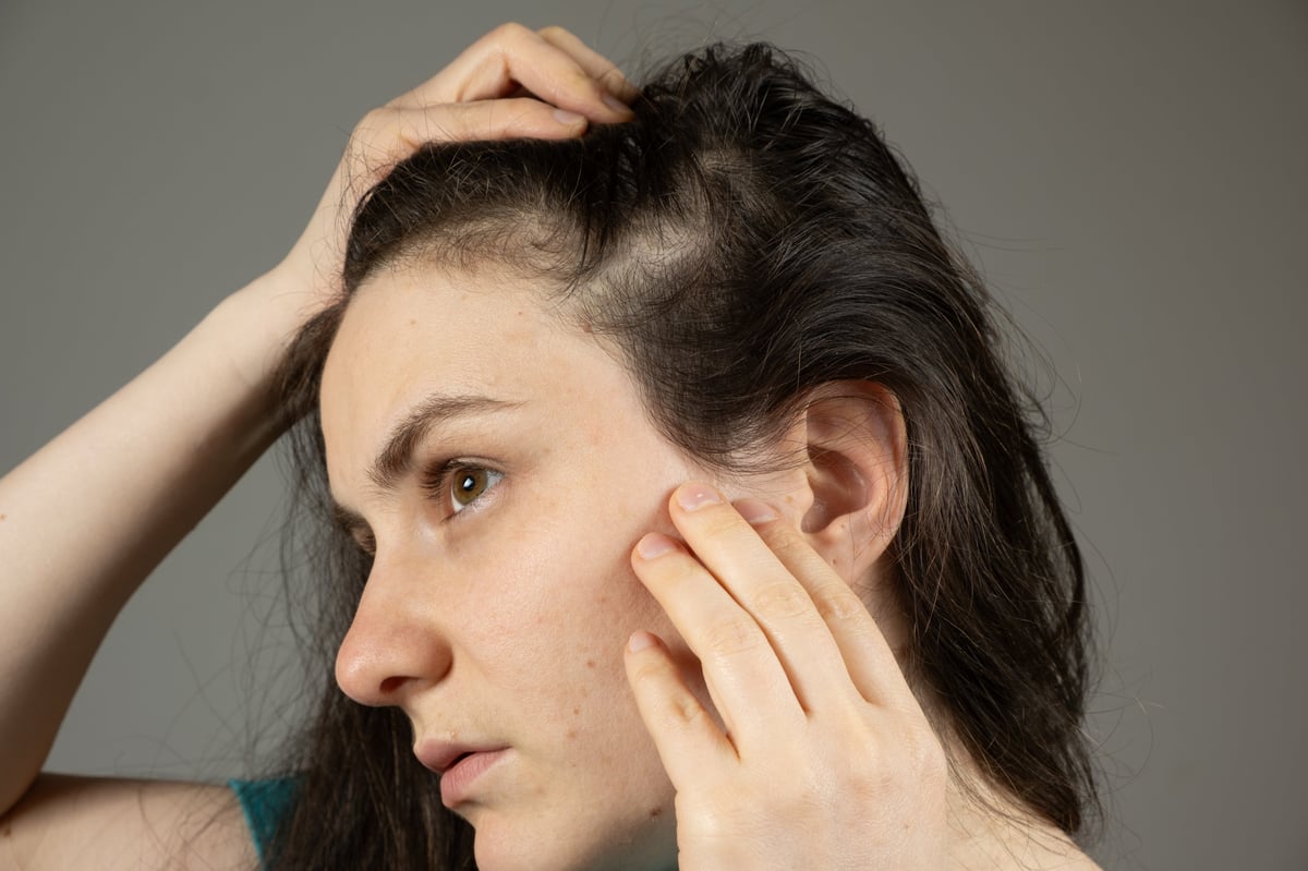 Worried young woman examining her thinning hair and scalp — female SMP density candidate