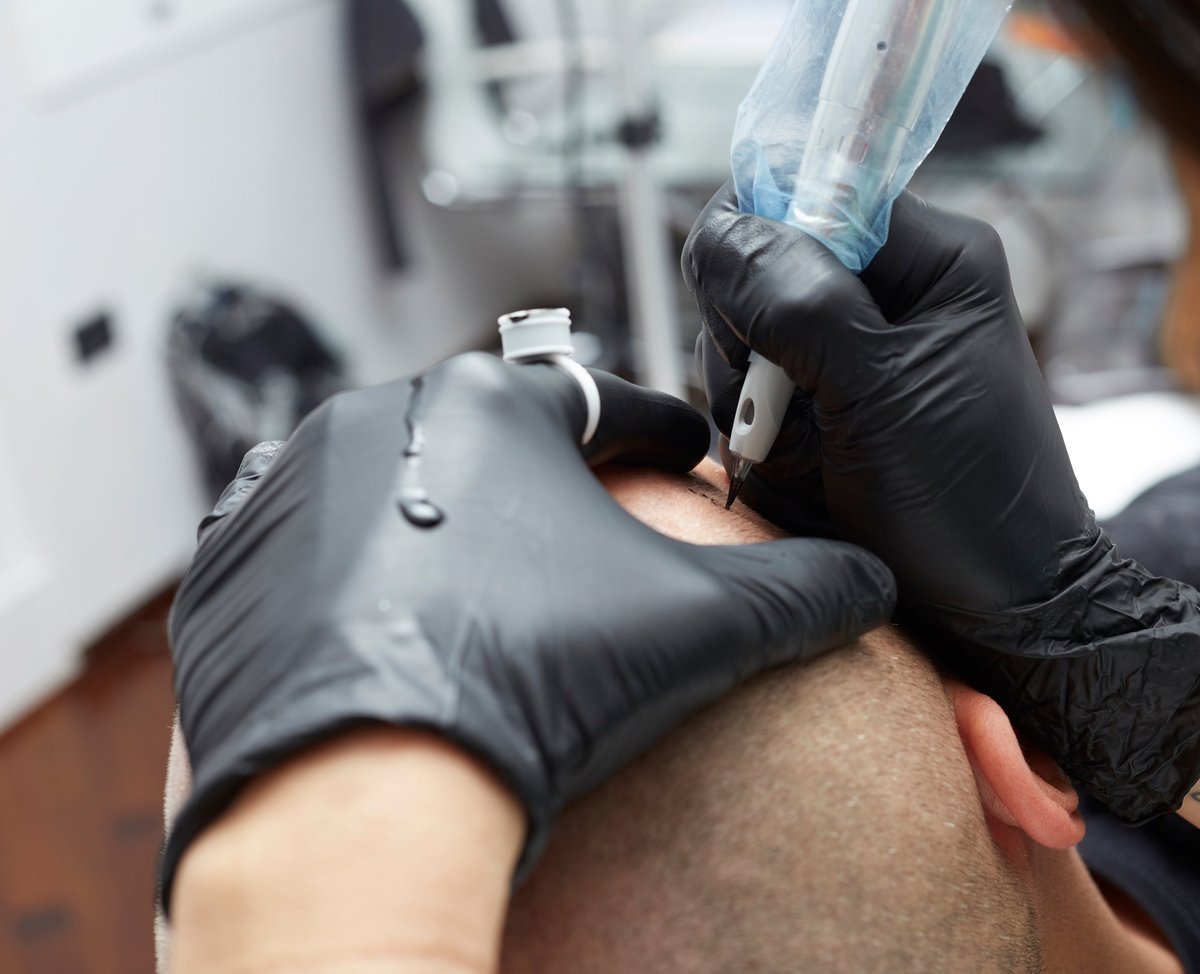 Men's SMP density enhancement procedure in progress